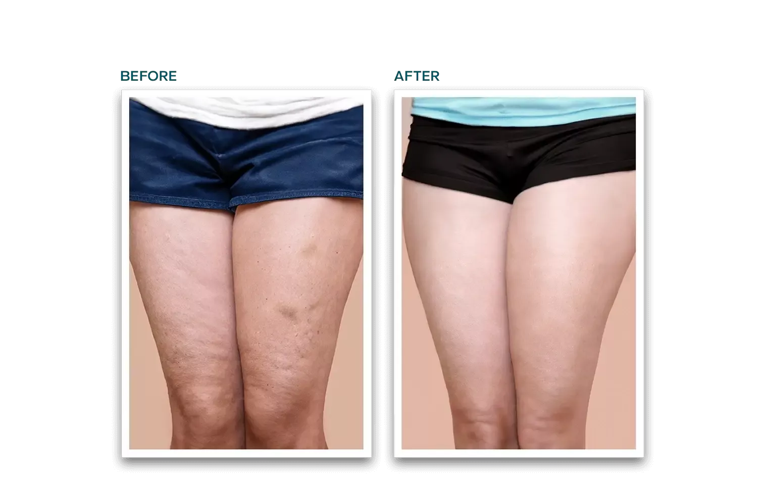 b12 injections for cellulite Mesotherapy - Spot Fat Reduction, Treatment, Skin Tightening | Non-Surgical Body Contouring B12 Volume:10ml – 10 vial lab pack (Save 10%) Reducing pain from intramuscular